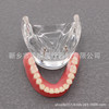 Dental teaching model doctor-patient communication model comprehensive case model removable dental model implant restoration model