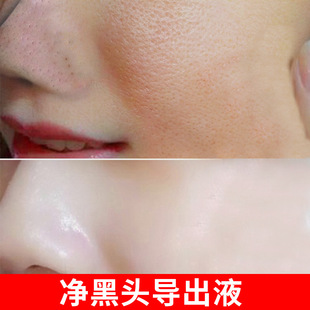 Blackhead Exusive Liquid Water Beauty Salon Special Blackhead Exusive Essence to Shrink Pore and Pore Pimples Nose Sticker Deep Cleansing Artifact