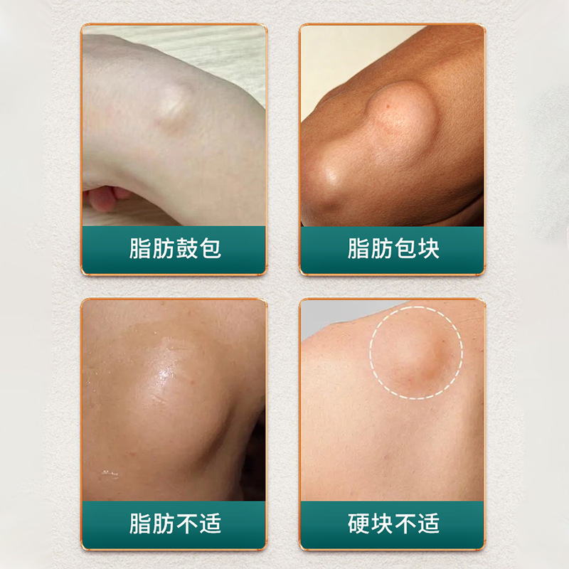正精研康脂肪保健贴舒缓皮肤脂肪包块结节难受不适硬包保健贴剂|undefined