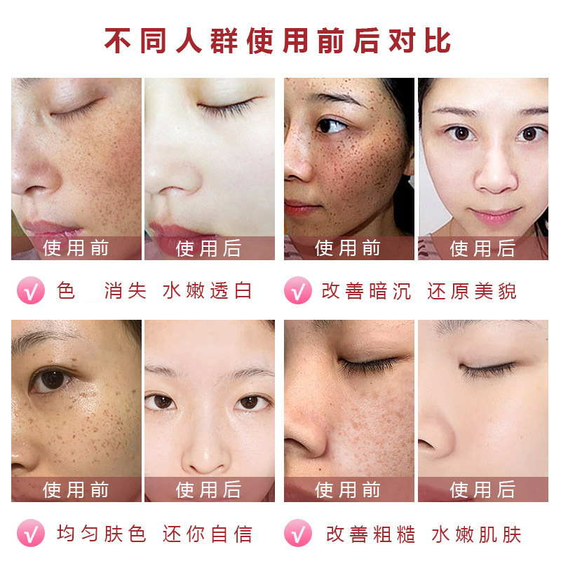 無期美白シミ取りクリーム淡化黄褐斑日焼け斑ソバカス老人斑淡化シミ改善くすみ|undefined