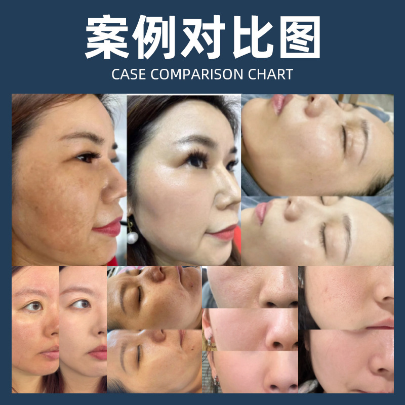 美容サロン専用の透析膜ディープクレンジング、鉛・水銀除去、毛包浄化ブラシ酵素による肌底修復スキンケア|undefined