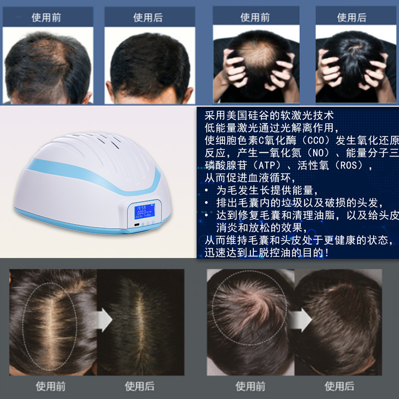 工場販売育毛器具、スクリーン付きインテリジェント赤色光育毛キャップ、オイルコントロール、脱毛防止、育毛レーザー、育毛と頭皮のメンテナンス|undefined
