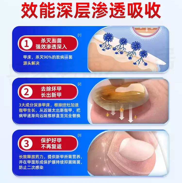 正虎制药灰甲康保健液灰甲净指甲增厚软甲液草本护理膏灰指甲液|undefined