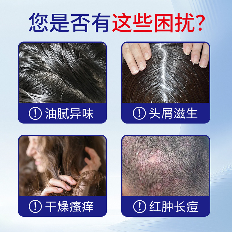 煤焦油洗剂头皮疙瘩毛囊受损堵塞清洁头皮痒止痒脂溢性洗剂洗头水|undefined