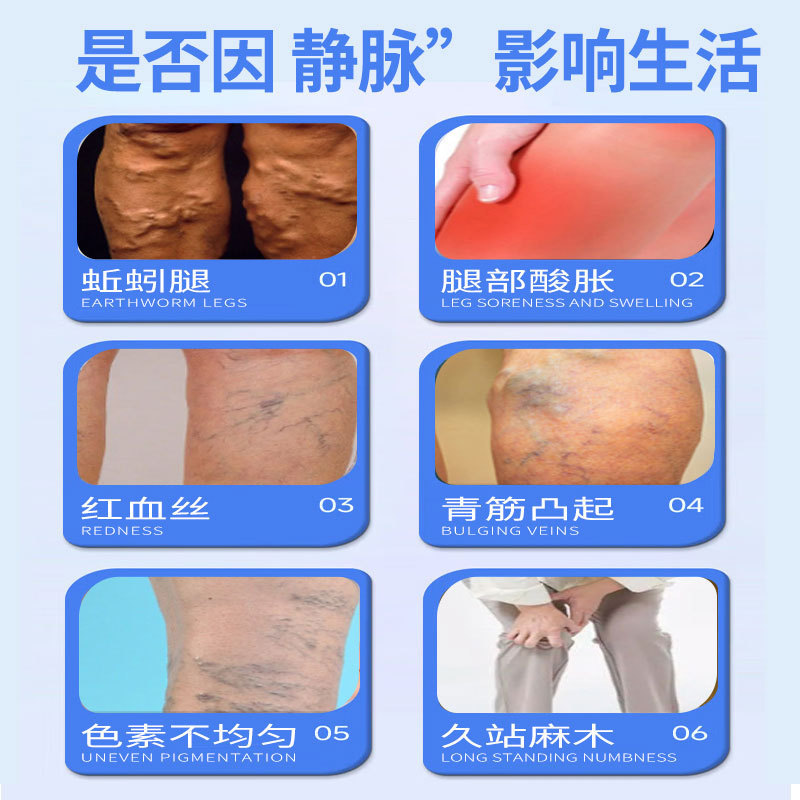静脉弯曲型护理喷雾腿部久站不适小腿酸胀血管突出弯曲腿部护理液|undefined
