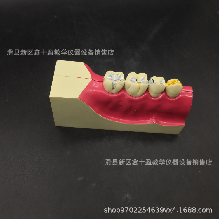 右下后牙组织分解模型 病理牙齿解刨牙神经线牙本质髓腔根管修复