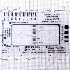 クロスボーダー心電図定規プラスチック定規測定ツール心電図心電図解釈のための心電図7ステップ定規