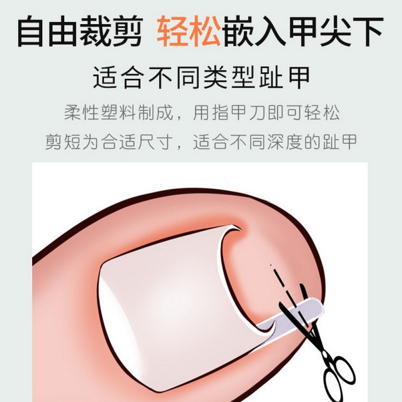 30個入りパッド-巻き爪矯正器 ピンセット 爪切り 爪溝矯正シート C型スロット 足指炎セット|undefined