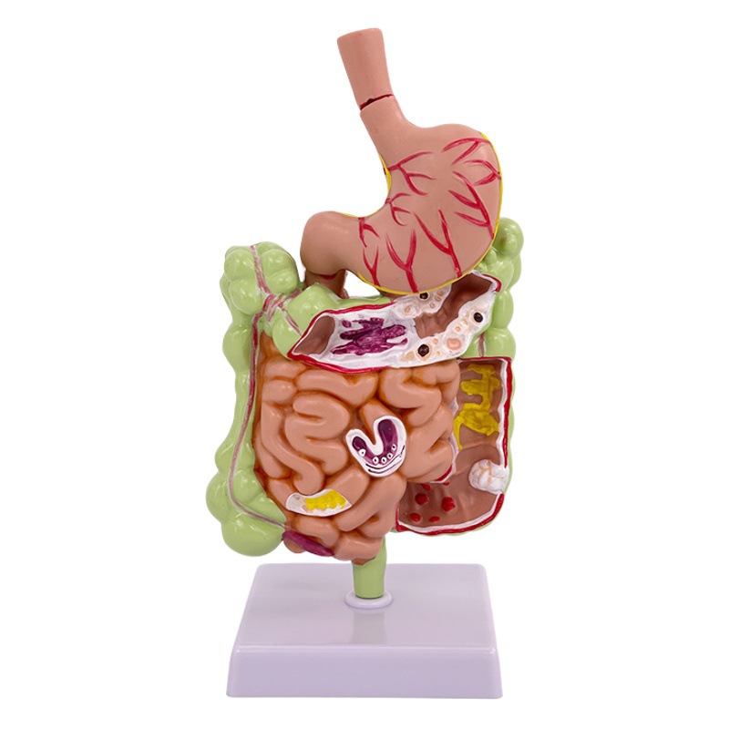 Modelo patológico de intestino grueso humano modelo anatómico gastrointestinal mórbido intestino grueso modelo rectal y duodenal