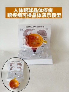 Corneal model eyeball anatomy removable pathological lens White internal Qingguang elderly eyes doctor-patient eye vision