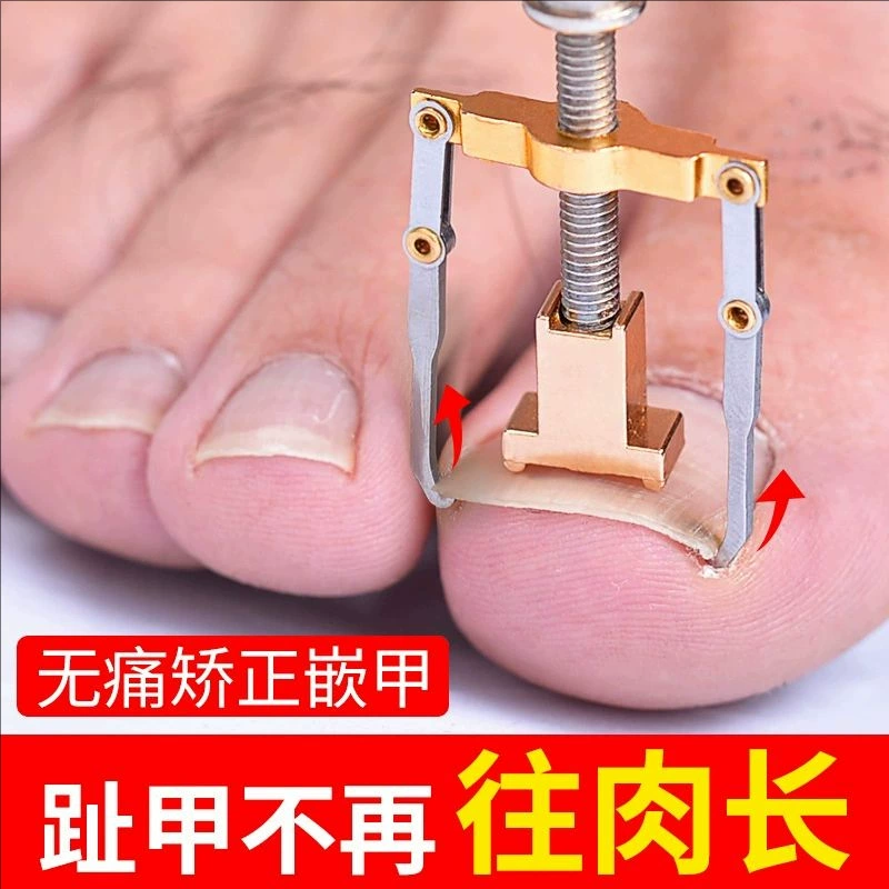 Корректор вросшего ногтя для педикюра, коррекция ногтей для вросших ногтей, коррекция паронихии