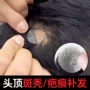 小面积少发男士疤痕真人发