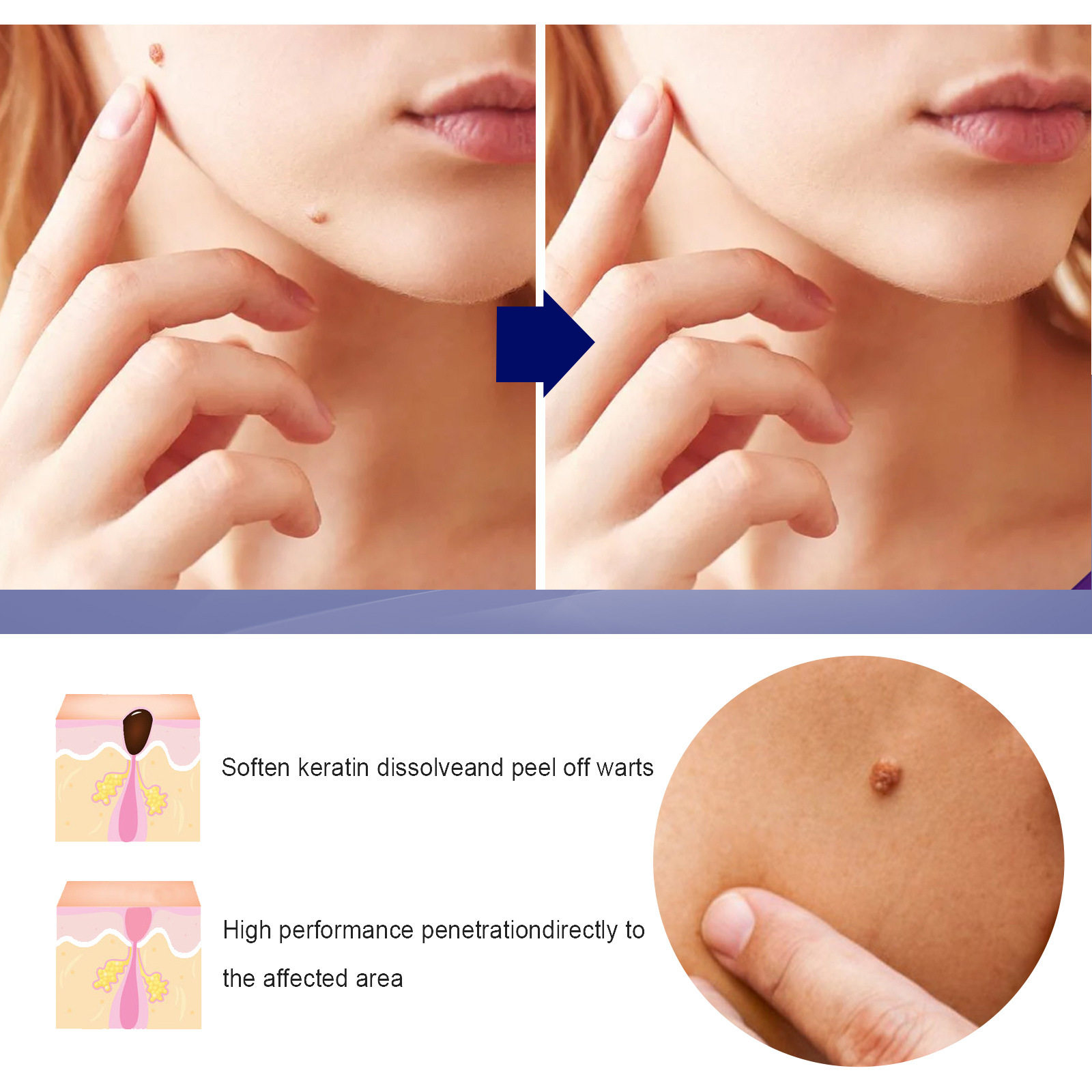 2023 Skin Label Borttagning Kyckling Ögonvård Rengöring Hud, kropp, ansiktsbehandling Flat Youke Wart Cream_voghion.com