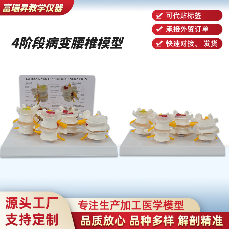 4-Stage Lesioned Lumbar Spine Model Orthopedic Teaching Display Teaching Aid Medical School Training Display Model Manufacturer