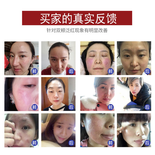 Sensitive Skin Repair Cream Centella Asiatica Essence Soothing Redness Thickening Stratum Corneum Beauty Salon Redness Reduction Face Cream