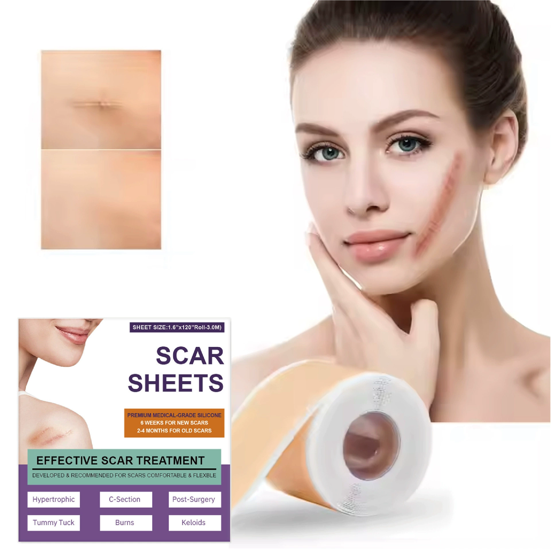 Силиконовые пластыри для ухода за кожей BUPY с самоклеящейся основой для уменьшения шрамов и ран