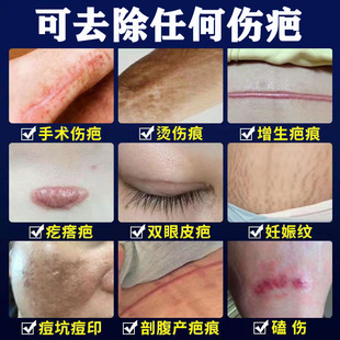 Scar Cream to Remove Old Scars, Old Scars, Repair Postoperative Hyperplasia, Caesarean Section Silicone Gel Scar Repair Cream
