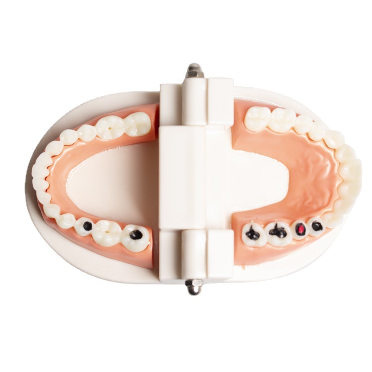 Modelo de caries dental para niños, modelo de cuidado de la enseñanza del cepillado de dientes de jardín de infantes, modelo de patología dental de la enseñanza oral