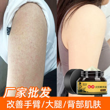 鸡皮肤蛇皮鱼鳞皮肤毛周角化疙瘩手臂大腿背部粗干燥身体乳嫩滑霜