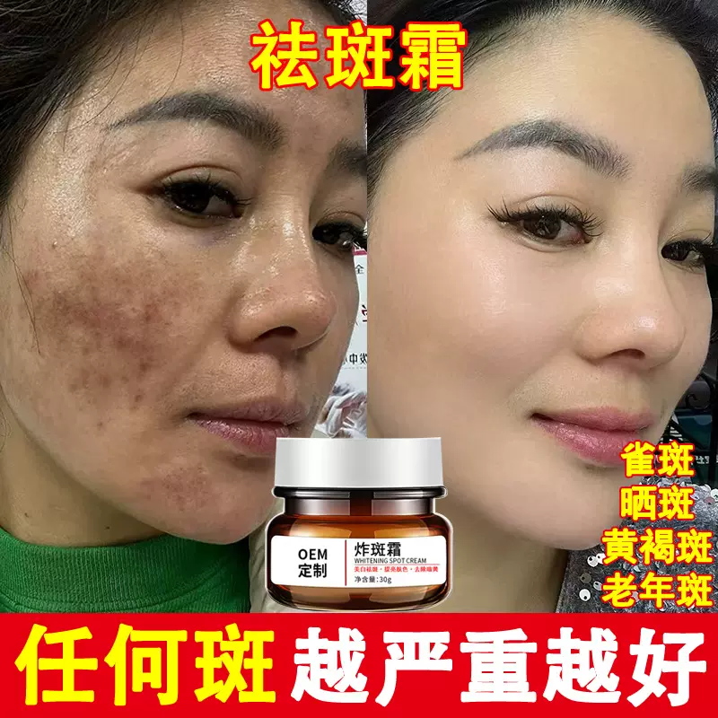 祛斑霜美白去黑色素源头去老年斑黄褐斑晒斑淡斑美容院专用炸斑霜
