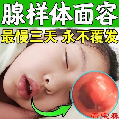 T【无添加】腺样体肥大面容矫正器儿童宝宝睡觉张嘴呼吸鼻塞中药|ms