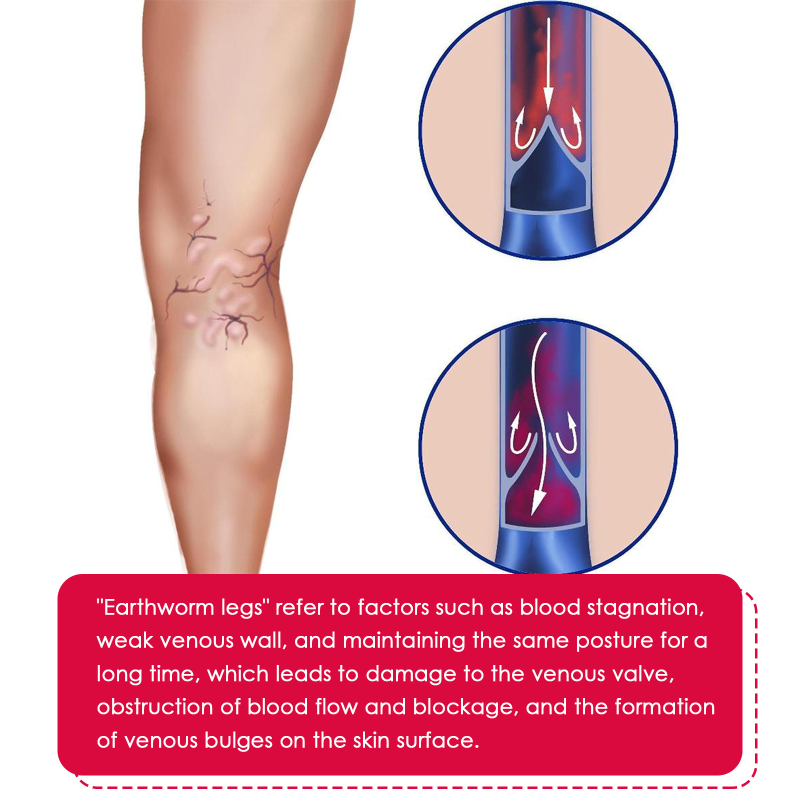 EELHOE Rose Venenpflege Ätherisches Öl Beinmassage Krampfadern Verbesserung der Durchblutung Lymphdrainage Beinpflege_voghion.com