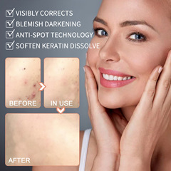 EELHOE 皮膚清潔克疣克尤液身體面部肉粒脖子絲狀平抑優瘊疣護理