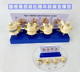 Human osteoporosis model spine bone density with age demonstration disc atrophy lumbar spine osteoporosis