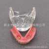 Dental teaching model doctor-patient communication model comprehensive case model removable dental model implant restoration model