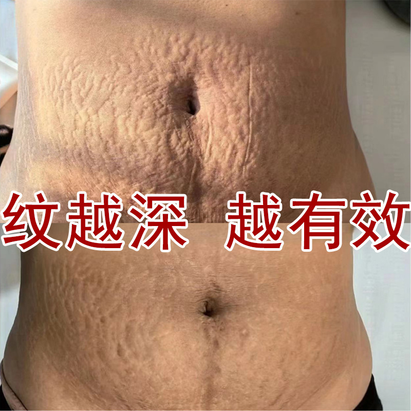 Stretch Mark Repair Cream Postpartum Repair to Remove Pregnancy Mark Fade Obesity Mark Growth Mark Tight Cream Soothing Scar Removal Cream Stretch Mark Repair Cream Postpartum Repair to Remove Pregnancy Mark Fade Obesity Mark Growth Mark Tight Cream Soothing Scar Removal Cream