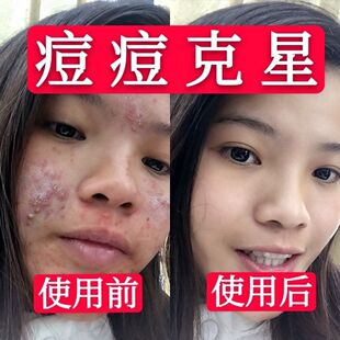 Dsm Acne Treatment Gel for Removing Acne Marks and Closed Comedones for Students, Direct Supply from Manufacturer for Both Women and Men