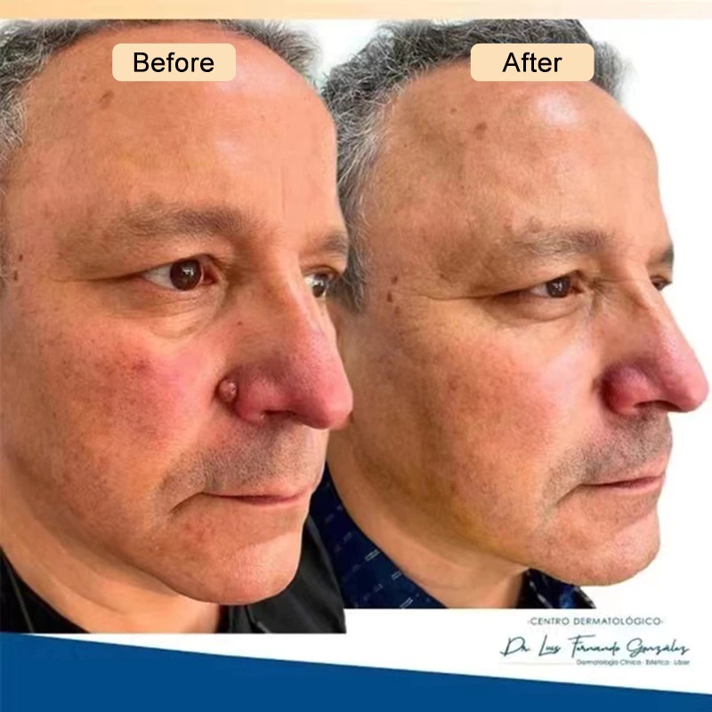 Stift für IBeaLee zum Entfernen flacher, besonders scharfer Warzen, Entfernerflüssigkeit, Creme und Warzenausgleichsflüssigkeit_voghion.com
