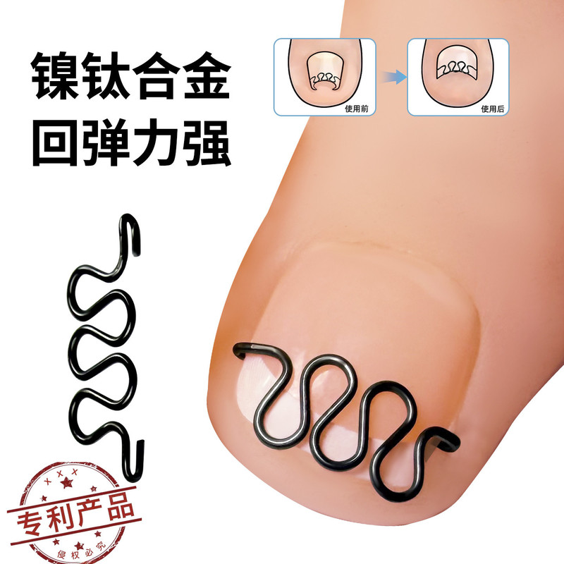 Toenail Groove Correction Nail Patch Nickel-Titanium Alloy Spring Nail Correction Ingrown Nail Correction Physical Stretching Nail Spring Wire
