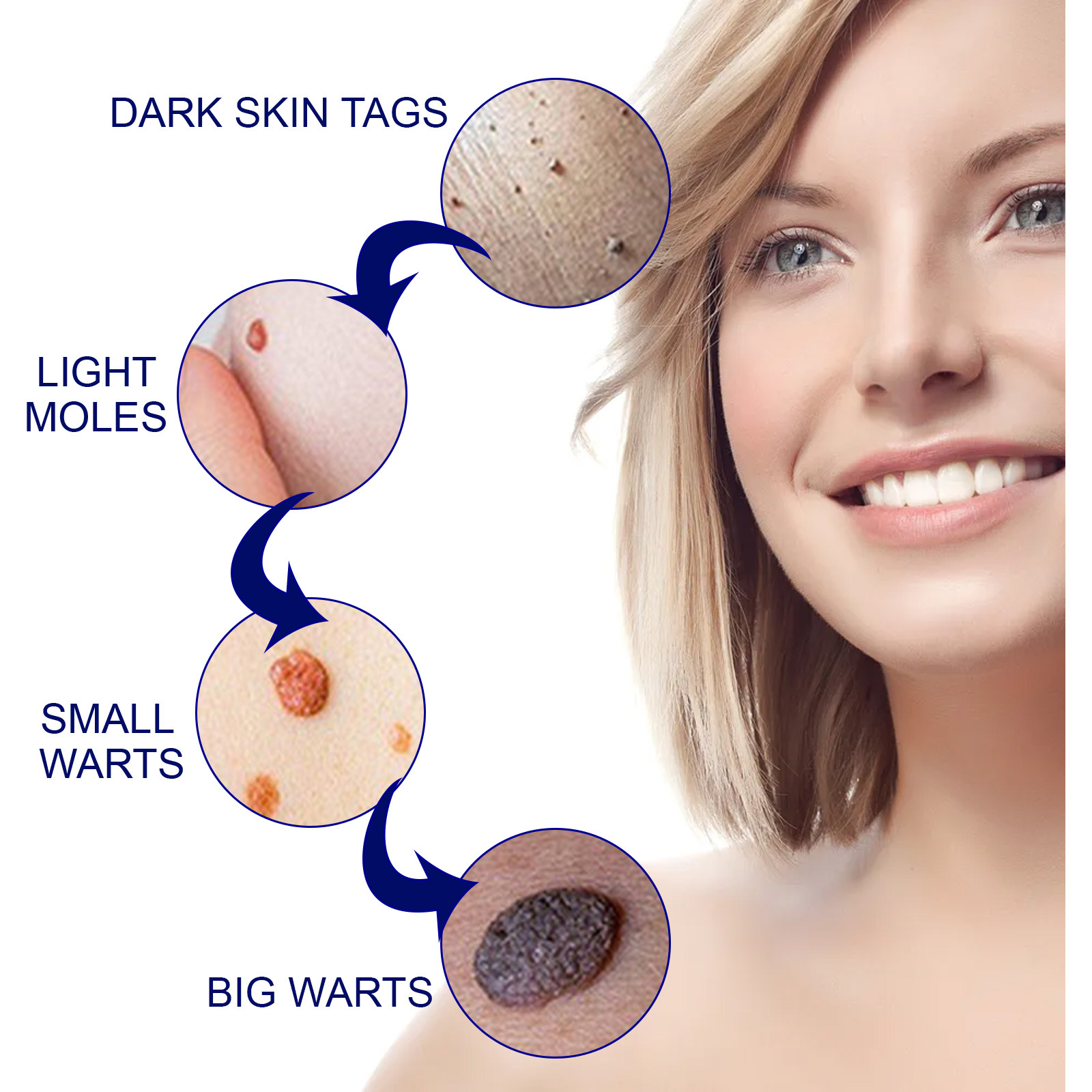 2023 Skin Label Borttagning Kyckling Ögonvård Rengöring Hud, kropp, ansiktsbehandling Flat Youke Wart Cream_voghion.com