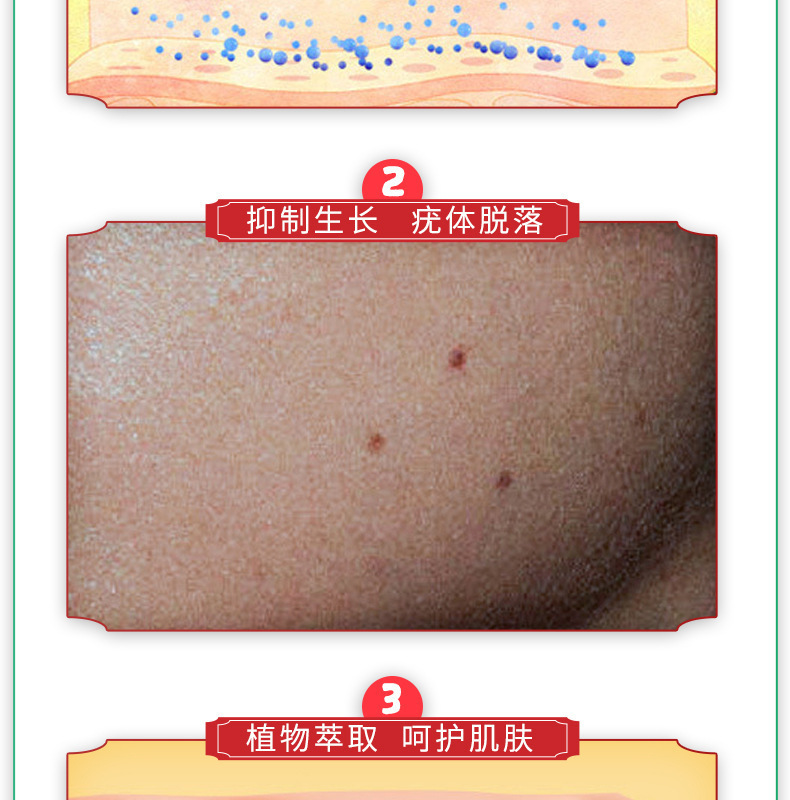 包邮去猴子脖子上长的小肉粒疙瘩药痦子腋下皮赘祛除瘊子肉痣-阿里巴巴