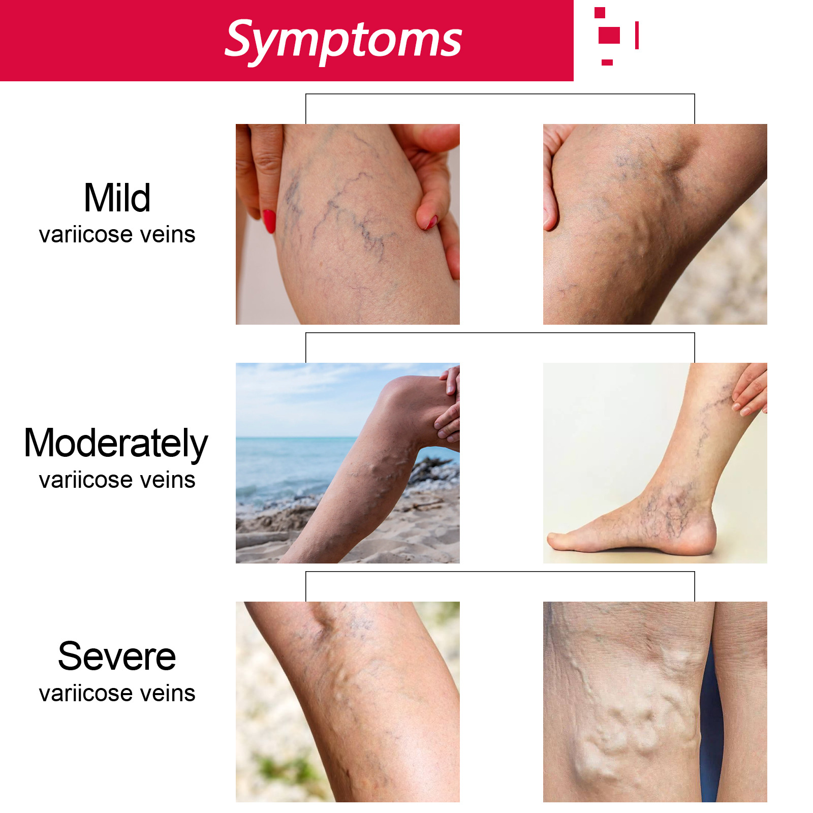 EELHOE Rose Venenpflege Ätherisches Öl Beinmassage Krampfadern Verbesserung der Durchblutung Lymphdrainage Beinpflege_voghion.com