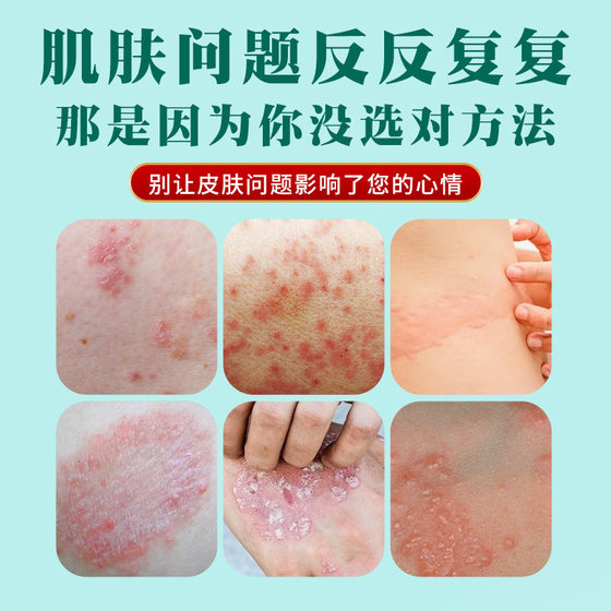 Japan Toda Vanilla Rain Dew Herbal Extraction Tinea Itching Intractable Antipruritic Moss Itching Cream Moss Itching Clearing Wholesale Daifa