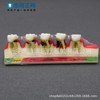 Dental teaching model doctor-patient communication model comprehensive case model removable dental model implant restoration model