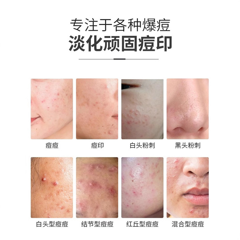 祛痘膏去痘痘护肤品套装淡化痘印祛痘精华液提亮祛痘印去闭口粉刺