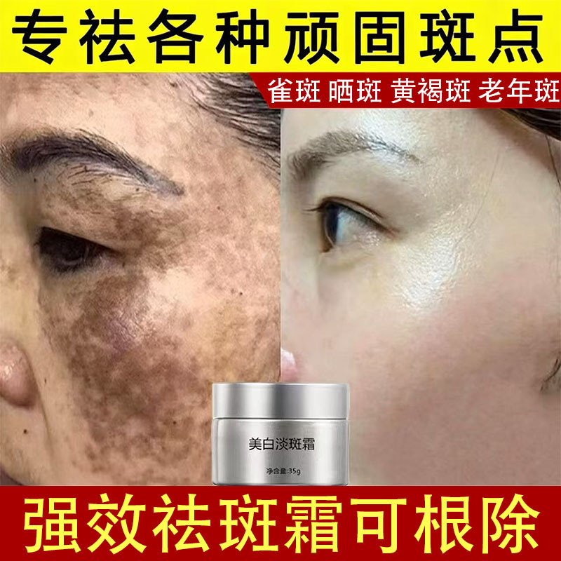 Whitening and Freckle Removal Cream, Powerful Melanin Removal, Chloasma, Age Spots, Sun Spots, Freckles, Color Control and Freckle Removal Essence Cream