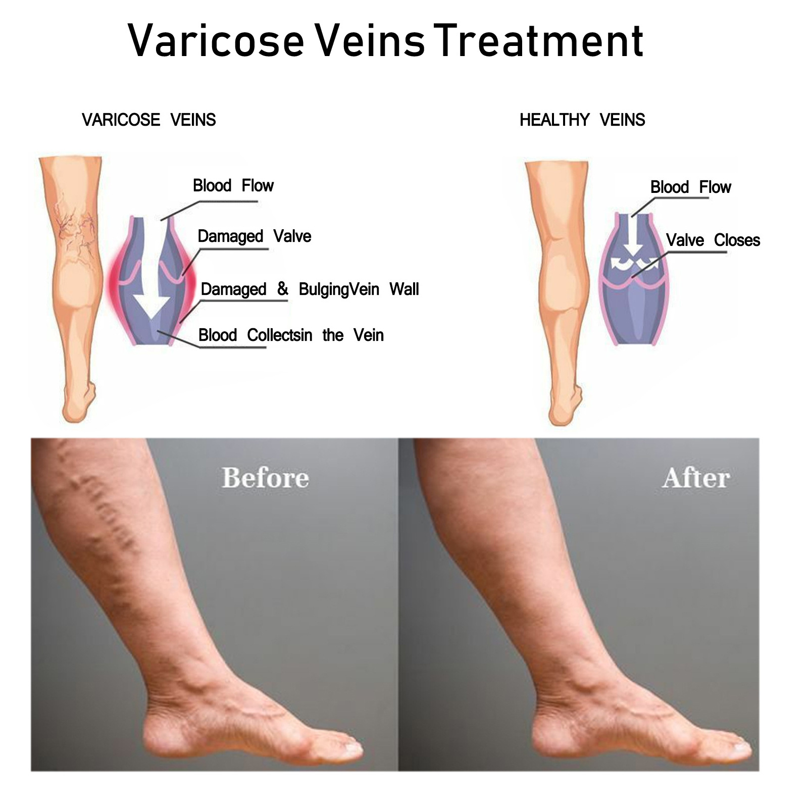 EELHOE Reparation Beroligende venøs venemassage Varicose Relief Ben Vaskulær svulmende smertecreme_voghion.com