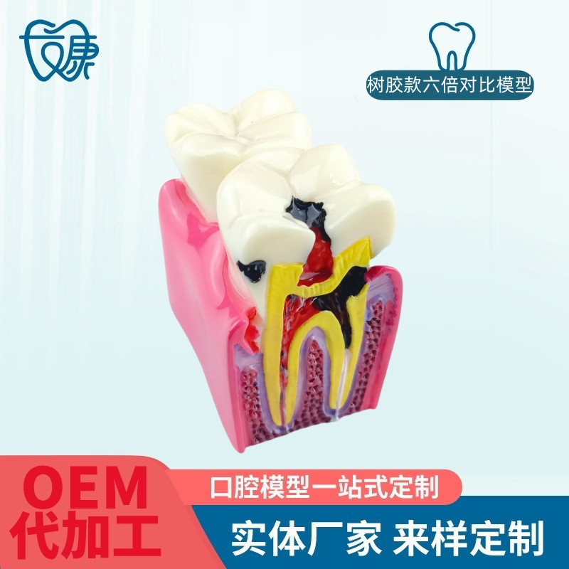 6 times contrast model dental teaching equipment 6 times caries contrast model oral model teaching tooth model