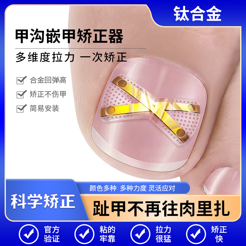 X-Shaped Nickel-Titanium Alloy Bionic Bone Patch for Ingrown Toenail Correction, Toenail Inflammation Corrector