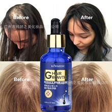�羳��Ʒ�^�l���ܾ��AAnti-hair Loss hair growth serum�o�l����