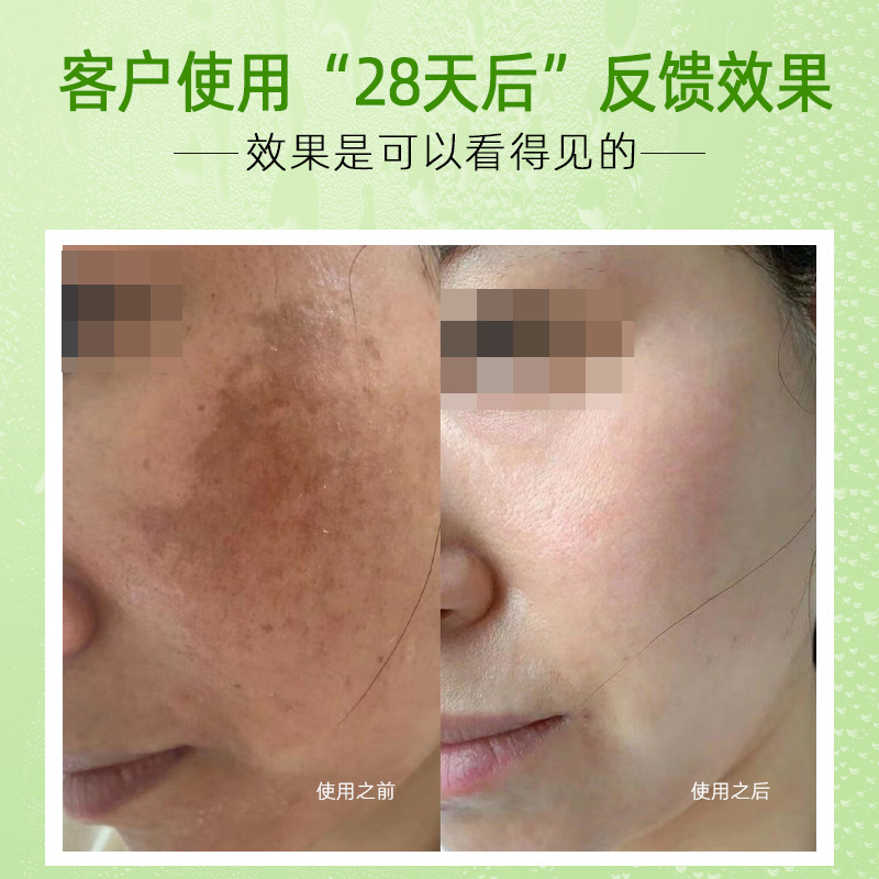 黄褐斑专用精华溶斑油反黑晒斑痘印原液精华液保养液祛斑液化妆品|undefined