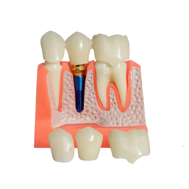 Modelo dental molde modelo dental modelo de enseñanza dental removible dentadura oral cepillado Preparación del diente modelo resina