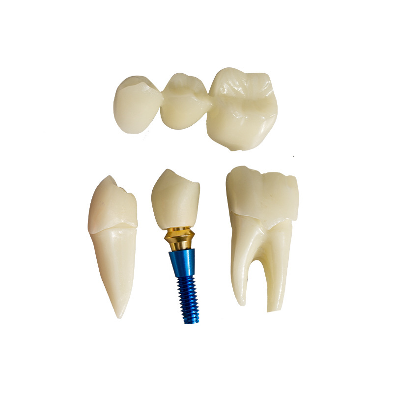 Dental 4 veces modelo de implante dentadura reparación implante interpretación puente desmontable corona modelo de implante