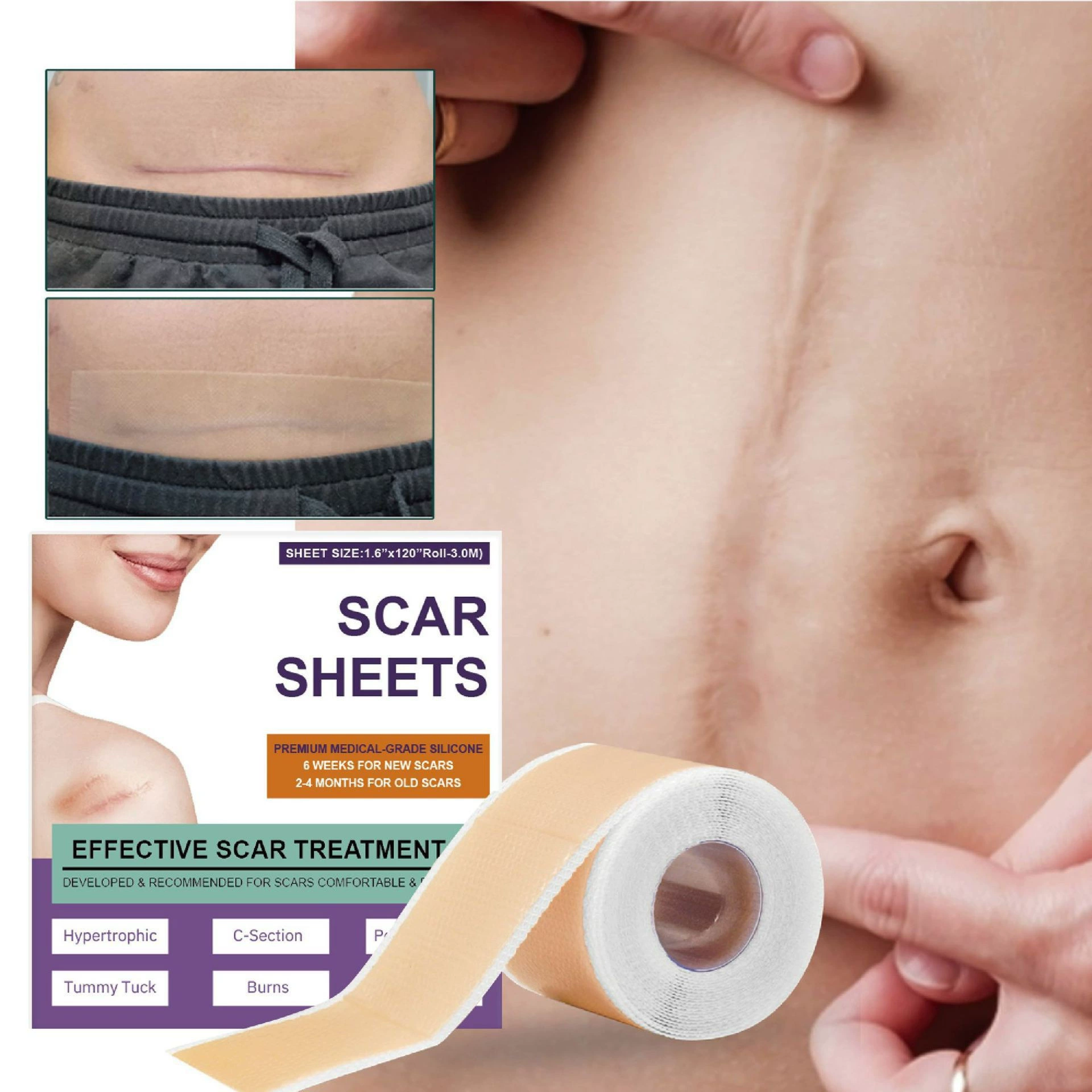 3m BUPY силиконовый самоклеящийся пластырь от шрамов, разглаживающий уход за ранами, исчезающие шрамы, хирургический пластырь для восстановления шрамов