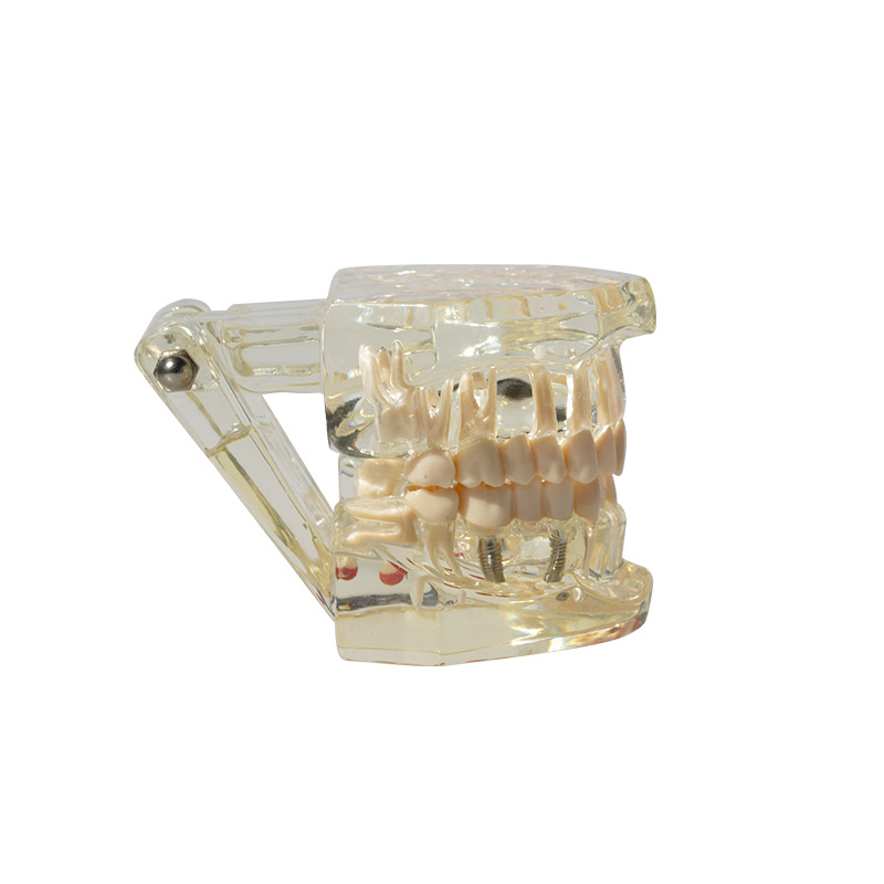 Modelo de implante dental, modelo dental patológico, modelo oral desmontable, modelo de explicación de puente, protección dental
