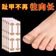 免胶水正甲贴甲沟嵌甲矫正器脚趾甲脚趾甲贴片拉拉修指甲用工厂货